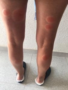 Picaduras mosquitos vecina Almassora